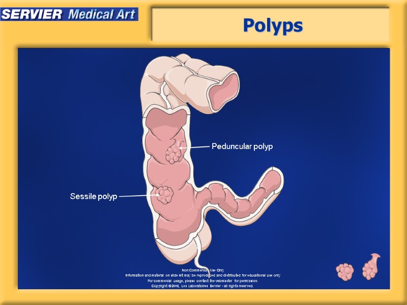Polyps Peduncular polyp Sessile polyp